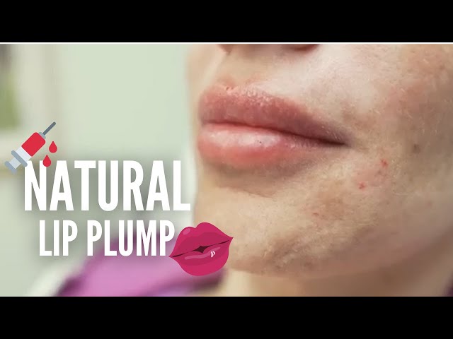 Natural Lips (Using Juvederm Ultra Plus XC) | Lips by Dr. Qazi