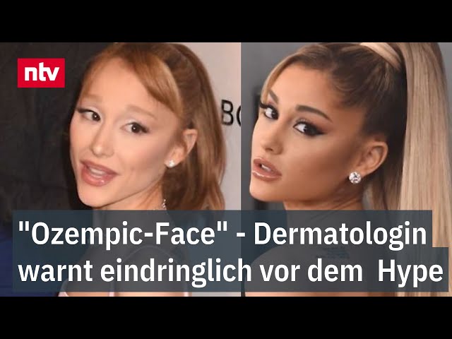 "Ozempic-Face" - Dermatologin warnt eindringlich vor dem  Hype