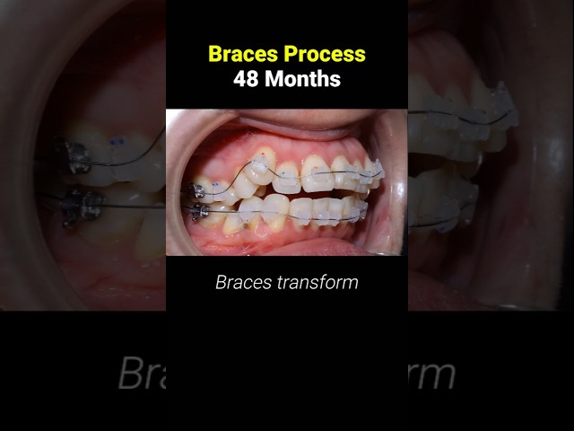 Braces in 48 months #braces #orthodontist #dentist #teeth