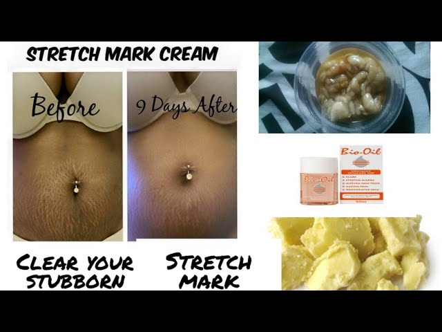 How to get rid of stretch marks supper infective | get a faster results