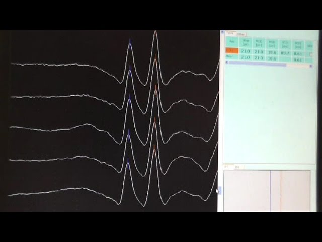 #Neuromuscular #junction tests (#Repetitive #Nerve #Stimulation and #Single #Fibre EMG)