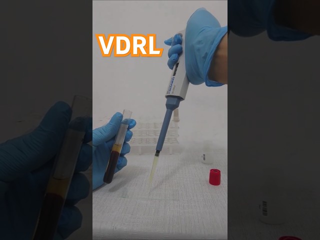 Así se observa una prueba VDRL positiva #shorts #laboratorioclinico #aids