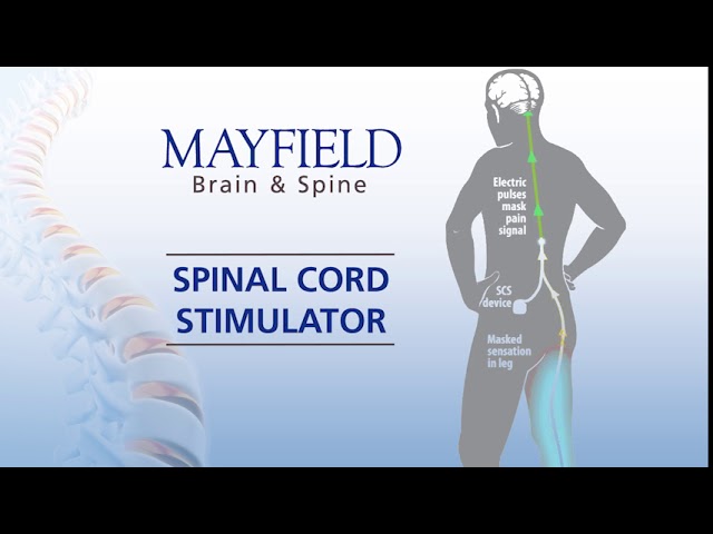 Mayfield Minute: Spinal Cord Stimulation