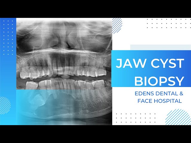 Jaw cyst biopsy|oral surgery|Dr.Dhineksh kumar face surgeon