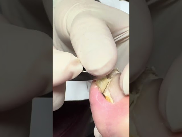 WHAT'S HIDING UNDERNEATH THIS NAIL??! (SPED UP) #nails #foot #impactedtoenail #nailcare #satisfying