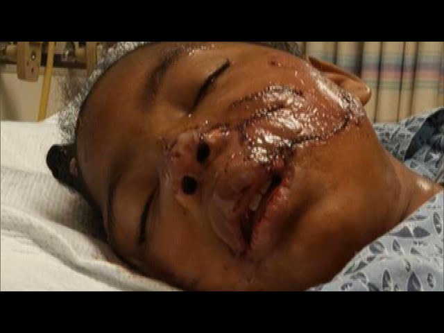 Procedure for Girl Who Survived Dog Attack