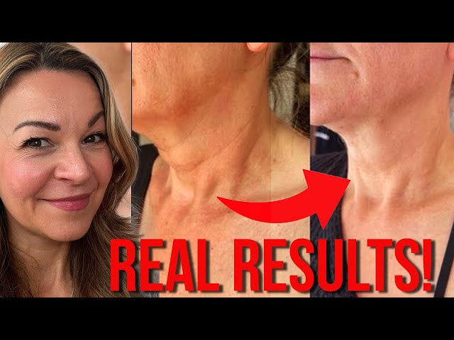 DIY turkey neck fix | Aesthetician got dramatic lift with this simple technique