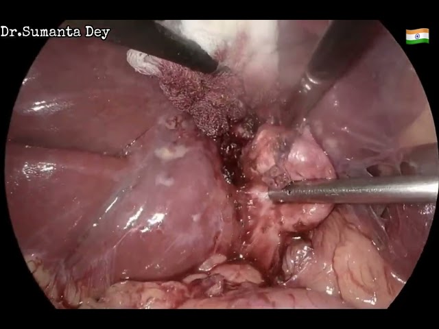 Stump Cholecystitis: Laparoscopic completion Cholecystectomy by Dr.Sumanta Dey