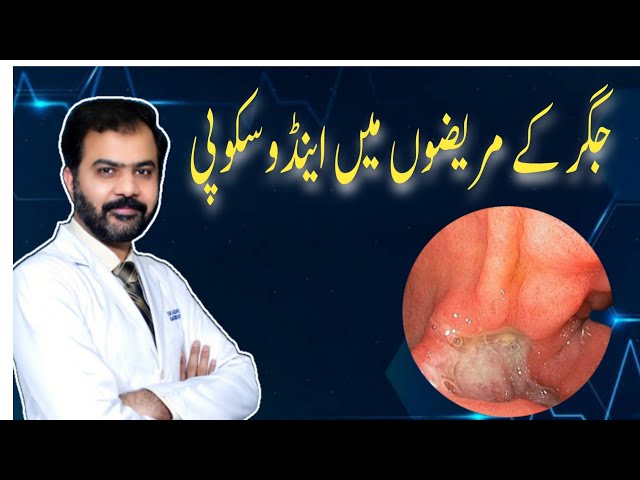 Endoscopy in liver cirrhosis | Dr Raja Ikram