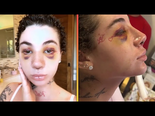 Bhad Bhabie DEFENDS Nose Job While Battling Cancer