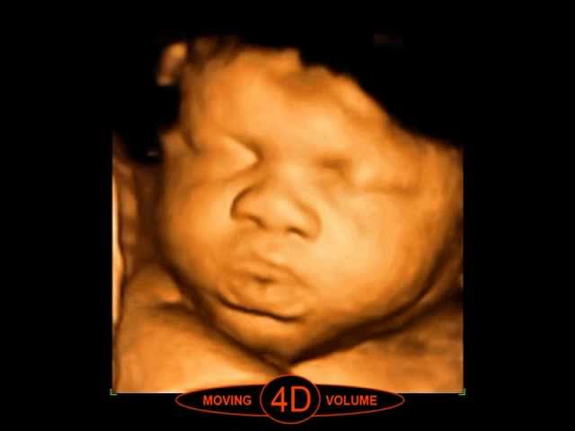 What is 4D ultrasound scan?