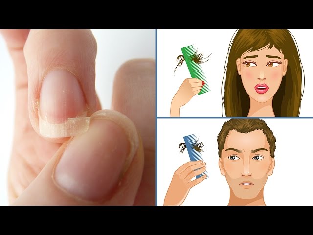 If You Have Thin Brittle Nails, Insomnia Or Hair Loss, Start Eating This!