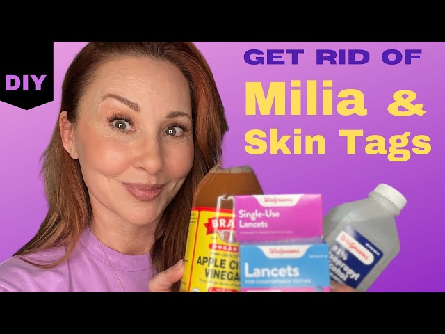 Get Rid of Milia & Skin Tags: At Home