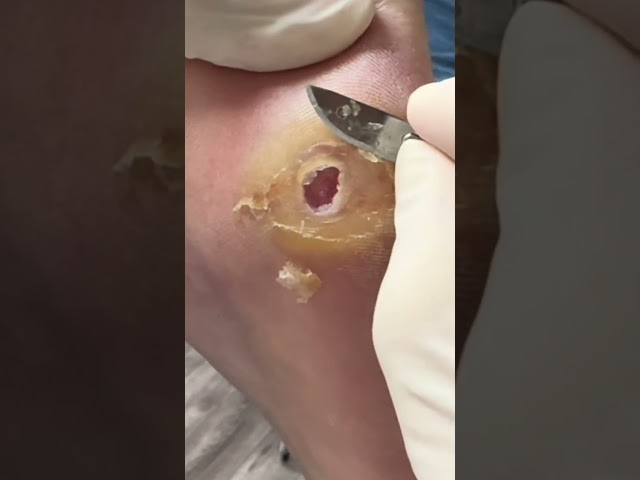 (MUST SEE) Satisfying Ulcer Debridement