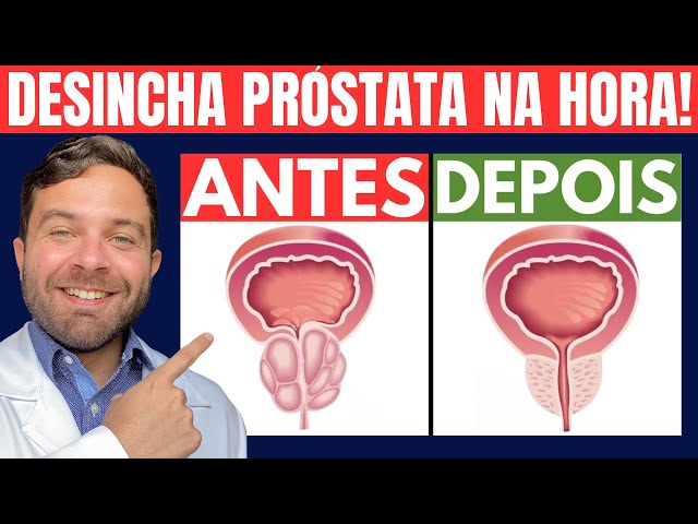 APENAS 3 ALIMENTOS para DESINCHAR PRÓSTATA AUMENTADA | Remédio Natural Hiperplasia Prostática (HPB)