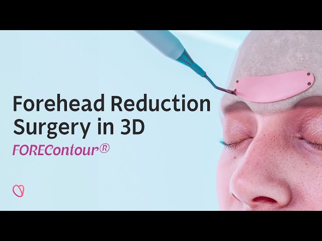 FOREContour® — Forehead Reduction Surgery in 3D