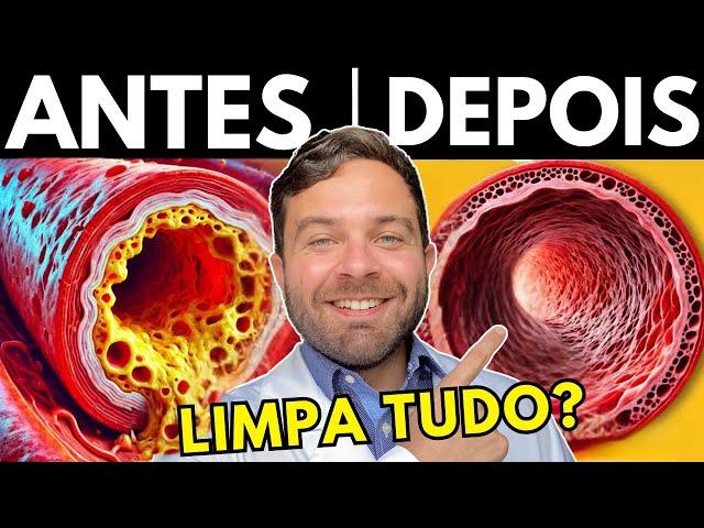 LIMPA as Artérias Entupidas SEM REMÉDIOS e RÁPIDO!