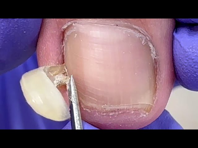 What a big hook! Trimming unusually hard toenails【Doctor Liu Pedicure】