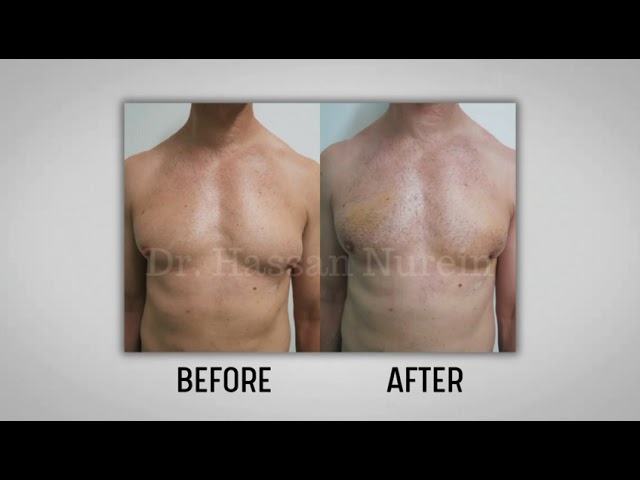 Grade 1-2 Gynecomastia Surgery Results | Dr Hassan Nurein