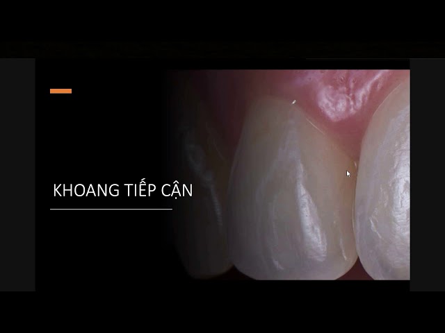 Diện tiếp xúc - khoang tiếp cận