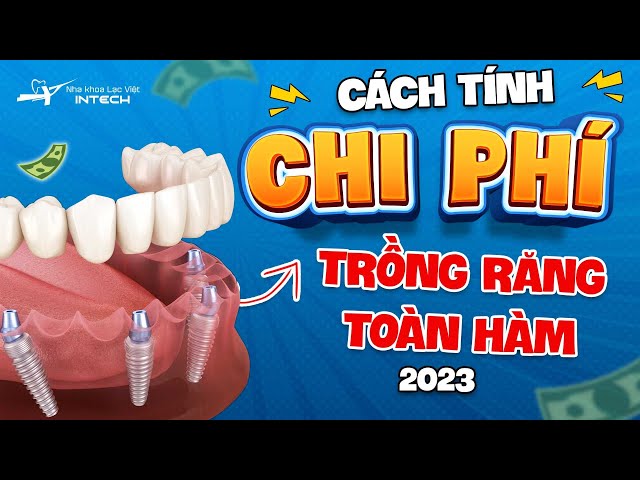 [Cập Nhật] Bảng Giá Trồng Răng Toàn Hàm I Cách Tính Chi Phí Đơn Giản Nhất