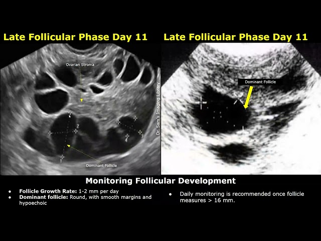 Follicular Monitoring of Ovary on Ultrasound | Ovulation & Fertility Tracking | Gynecological USG