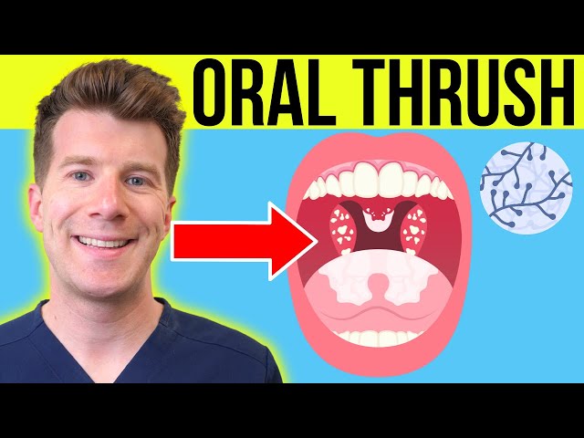 Doctor explains ORAL THRUSH (Oral Candidiasis) | Symptoms, treatment, & prevention in adults/babies