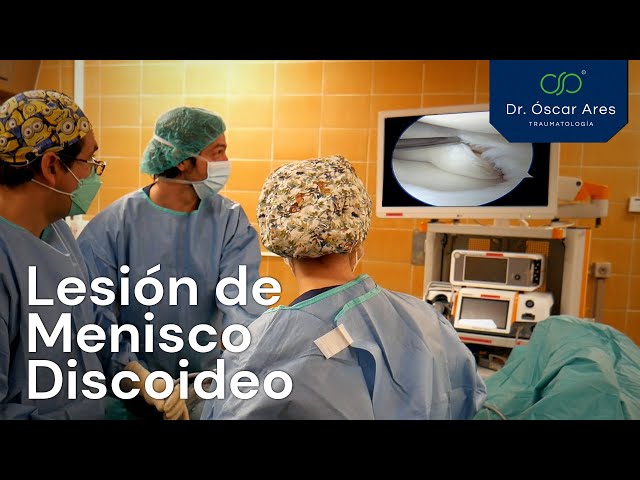 Lesión de menisco discoideo - Dr. Oscar Ares