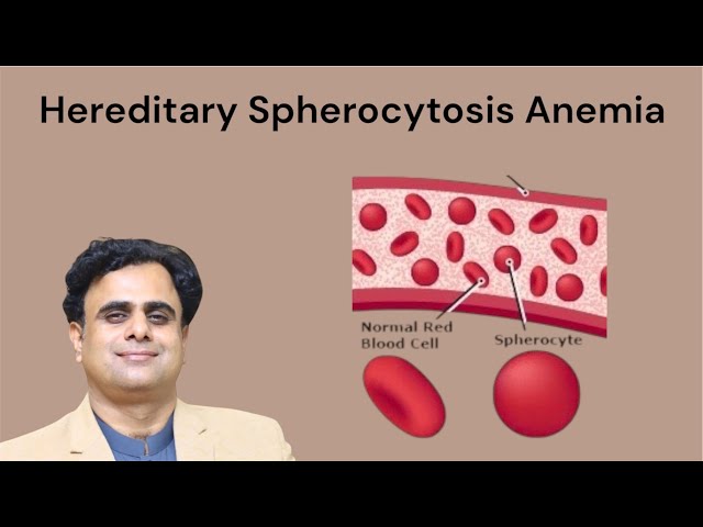 Hereditary Spherocytosis Anemia