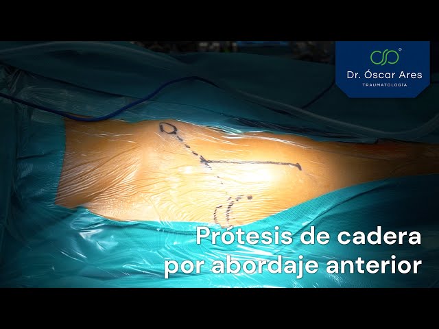 Prótesis de cadera por abordaje anterior - Dr. Oscar Ares