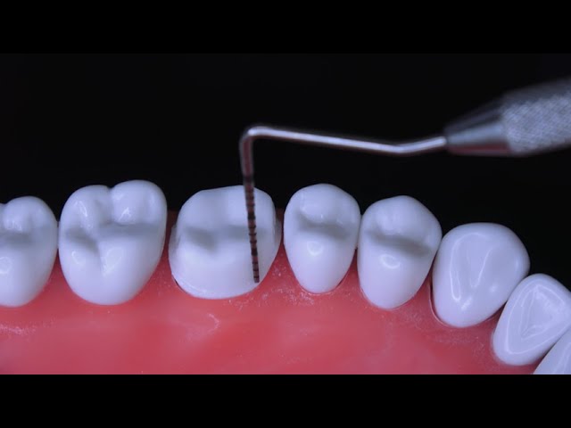 All Ceramic crown preparation for tooth #3 - Step by step