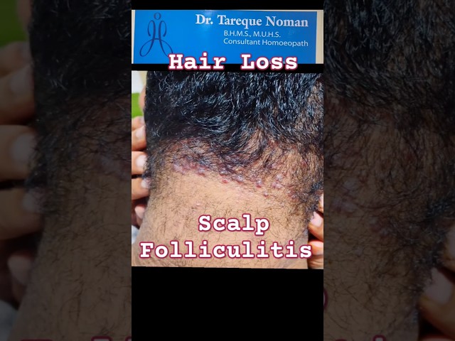 Scalp Folliculitis Treatment | Pimples on Scalp? Causes, Symptoms & Home Remedies #hairfollicle