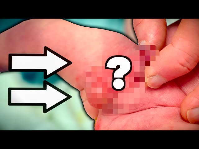 HELP! SOMETHING'S WRONG WITH MY BABY'S PENIS! (Hypospadias) | Dr. Paul