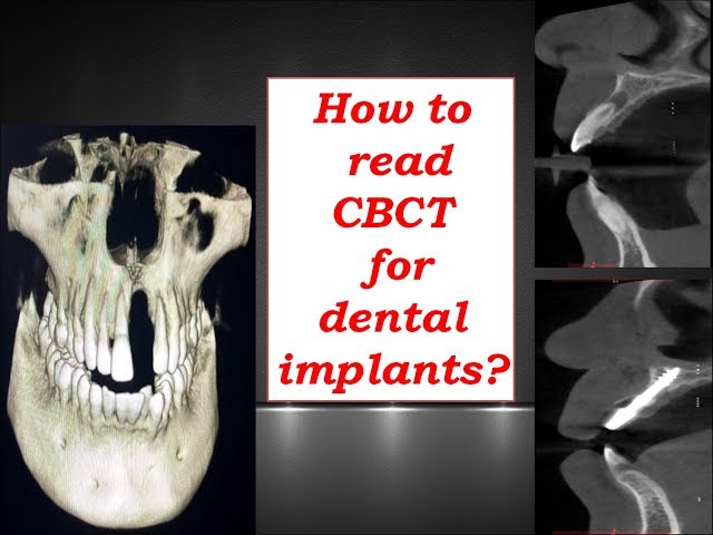 How to read CBCT for dental implants - Discussion by Dr.Murugavel