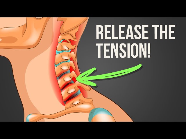 Neck Tension Syndrome: Cause & Two Easy Exercises