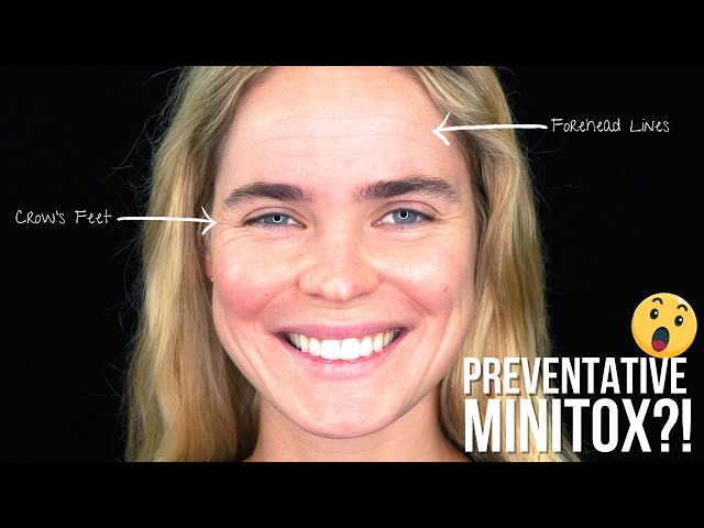 Preventative Minitox?! 💉😮 Keep Your Youthful Appearance With This Method of Botox