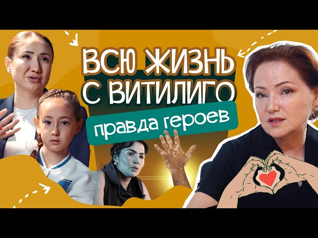 Белые пятна. Документальный фильм про Витилиго