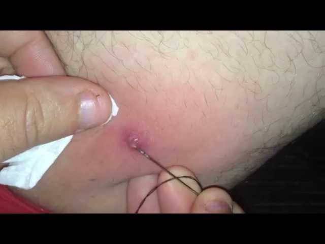 Popping BOIL Betwen Legs Part 1