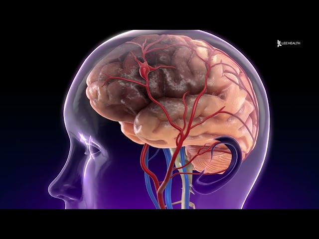 What is a Brain Aneurysm?