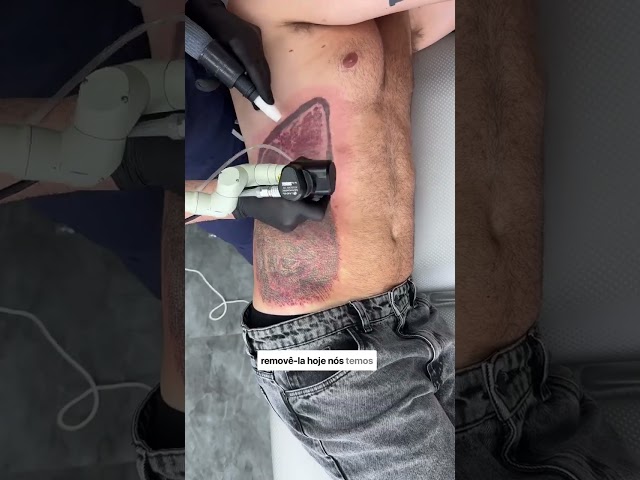 Leão na boca do tubarão a tatuagem mais peculiar do mundo animal até agora | Remoção de Tatuagem