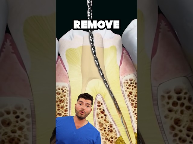 Root Canal Explained !?