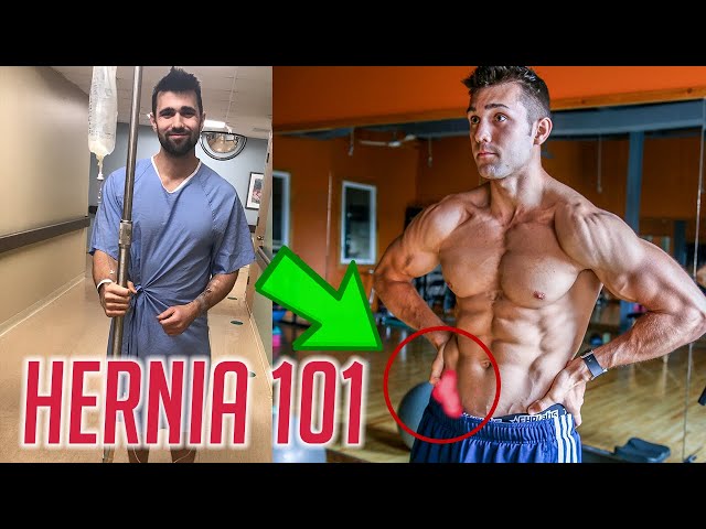 Inguinal Hernia Surgery Fast Recovery Tips & What To Expect