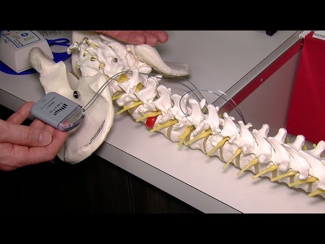 Local medical team offers Spinal Cord Stimulation to help back pain