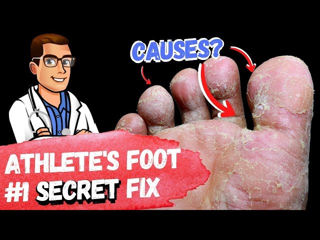 BEST Athlete's Foot Fungus Treatments [HOME Remedies + 3 BIG SECRETS]