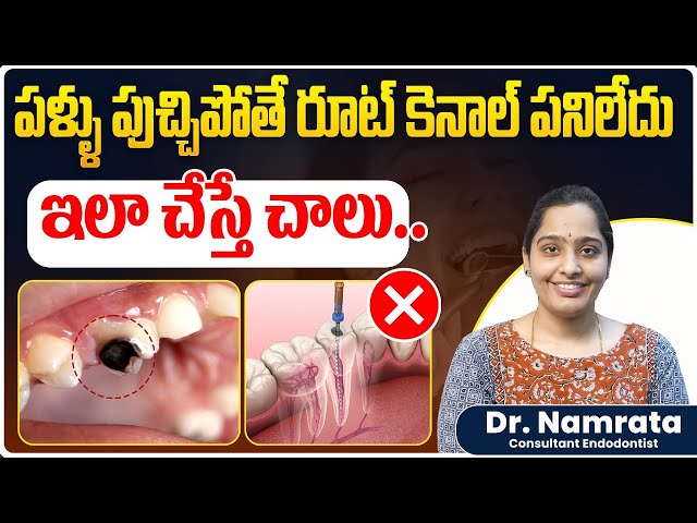 How to prevent cavities and tooth decay from getting worse || Cavities to Healthy Teeth || Eledent