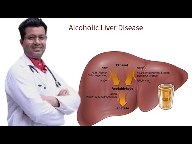 शराब से संबंधित लिवर रोग, Alcoholic Liver Disease | How much alcohol damages liver | Dr Rakesh Kumar