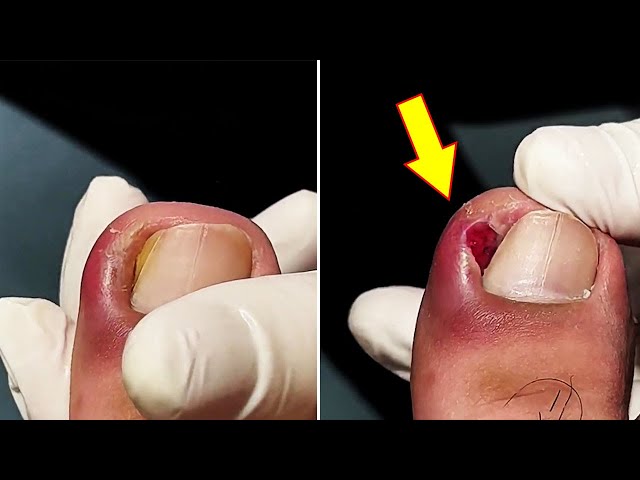 Ep 3175 Ingrown toenail removal [foot massager]