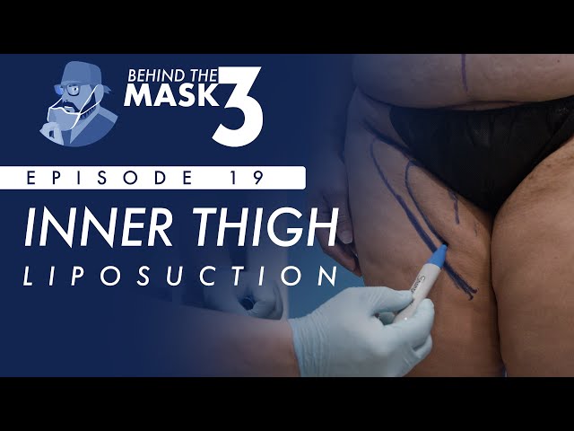 Thigh Liposuction - Are You a Candidate?