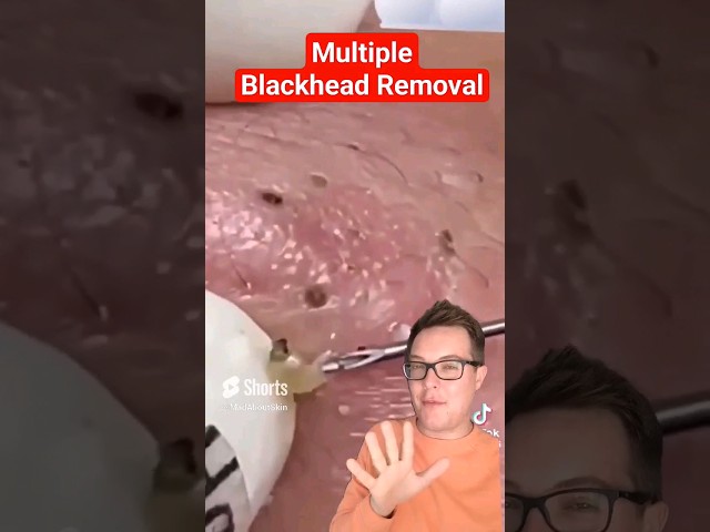 Record Breaking BLACKHEAD REMOVAL - Most Blackhead Pops #shorts