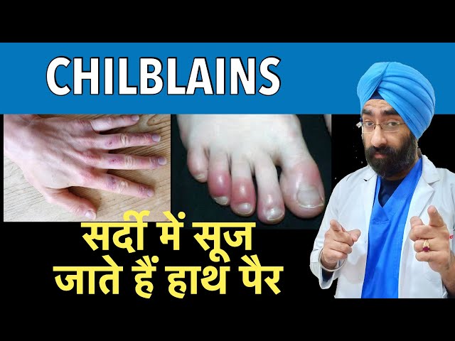 Chilblains : सर्दी में सूज जाते हैं हाथ पैर | Swollen hands and fingers in Winter | Dr.Education